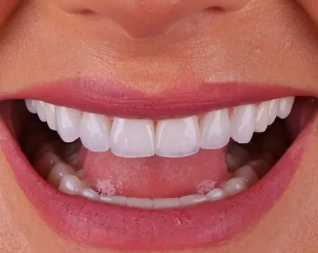 Lentes de contato dental